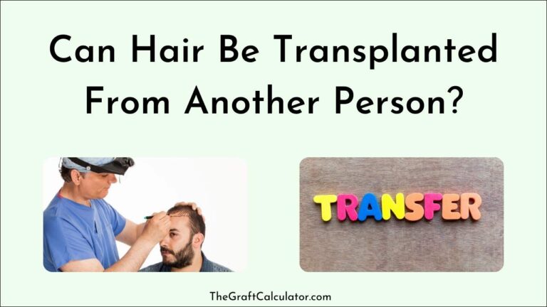 Can Hair Be Transplanted From Another Person?